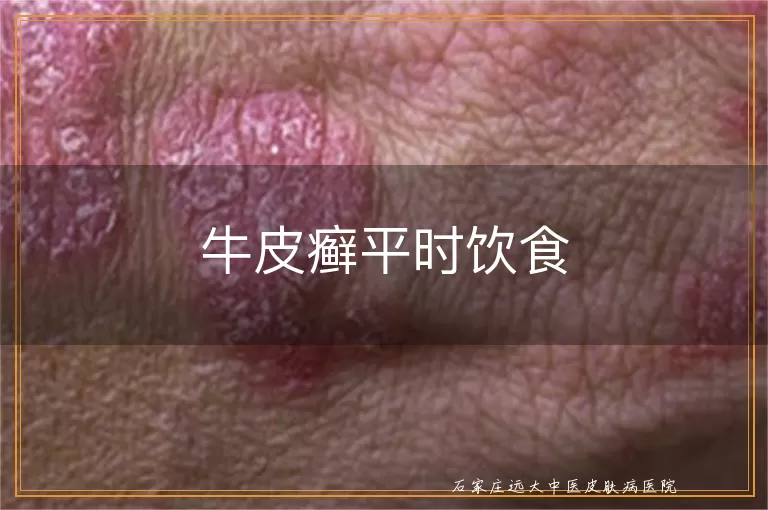 牛皮癣平时饮食