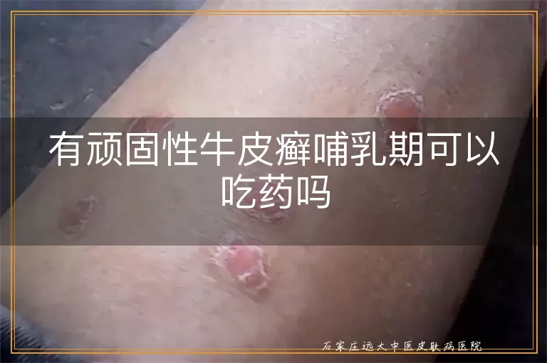 有顽固性牛皮癣哺乳期可以吃药吗