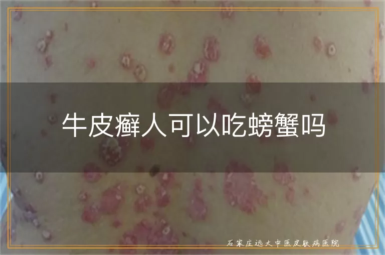 牛皮癣人可以吃螃蟹吗