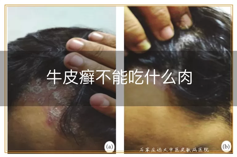 牛皮癣不能吃什么肉