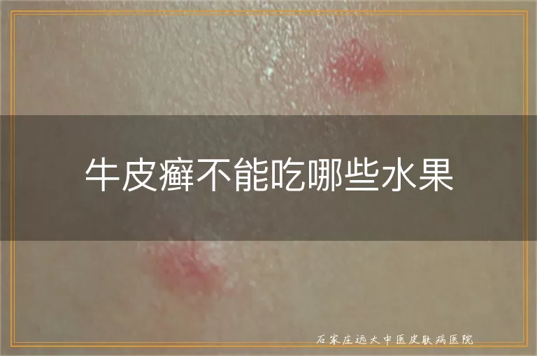 牛皮癣不能吃哪些水果