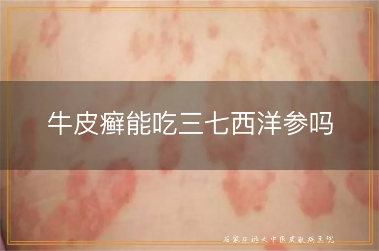 牛皮癣能吃三七西洋参吗
