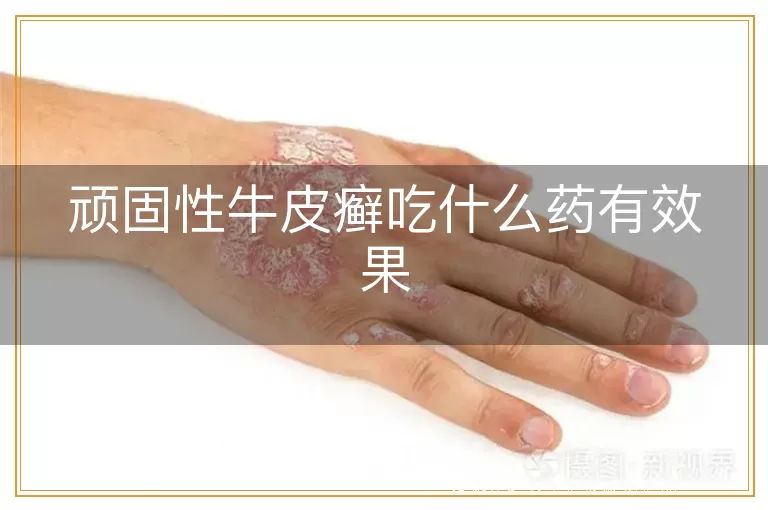 顽固性牛皮癣吃什么药有效果