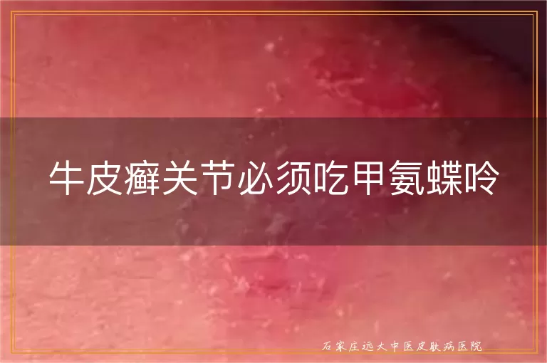 牛皮癣关节必须吃甲氨蝶呤