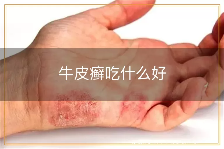牛皮癣吃什么好