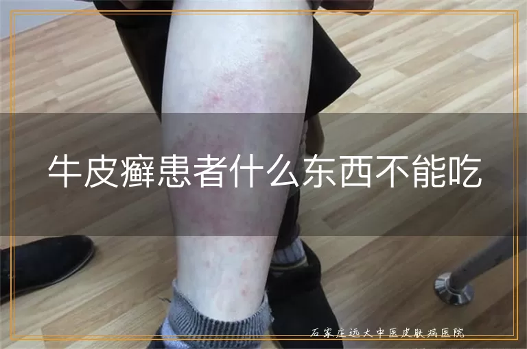 牛皮癣患者什么东西不能吃