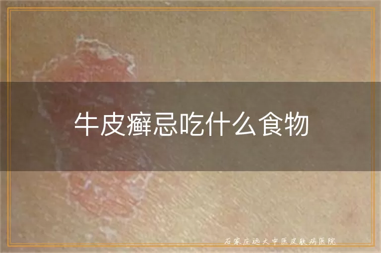 牛皮癣忌吃什么食物