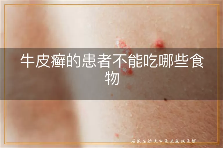 牛皮癣的患者不能吃哪些食物