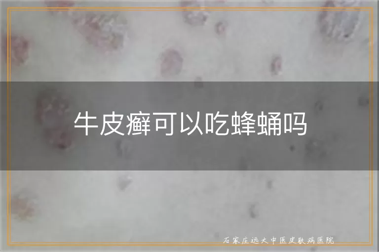 牛皮癣可以吃蜂蛹吗