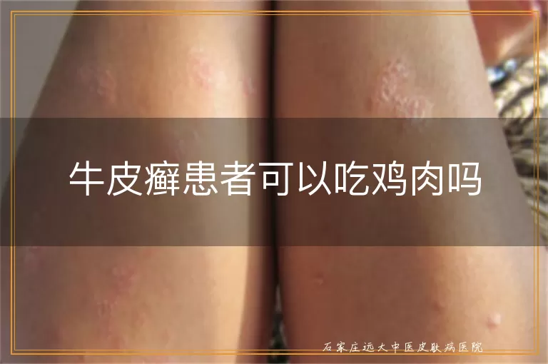 牛皮癣患者可以吃鸡肉吗