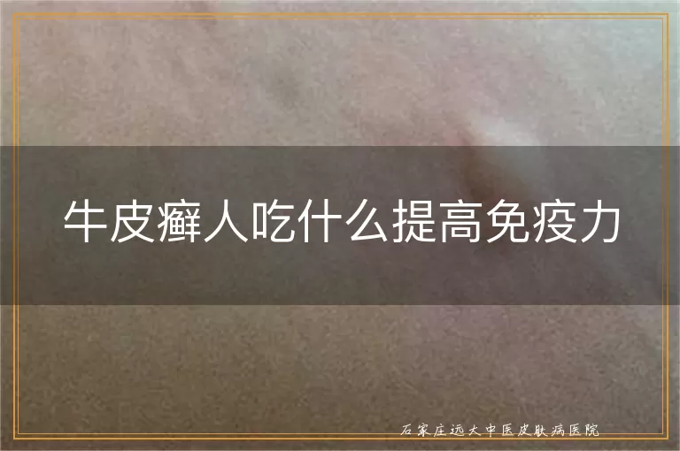 牛皮癣人吃什么提高免疫力