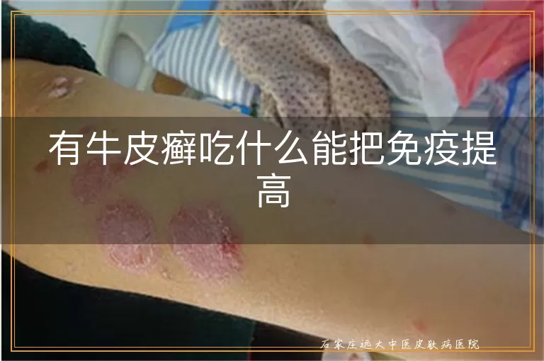 有牛皮癣吃什么能把免疫提高