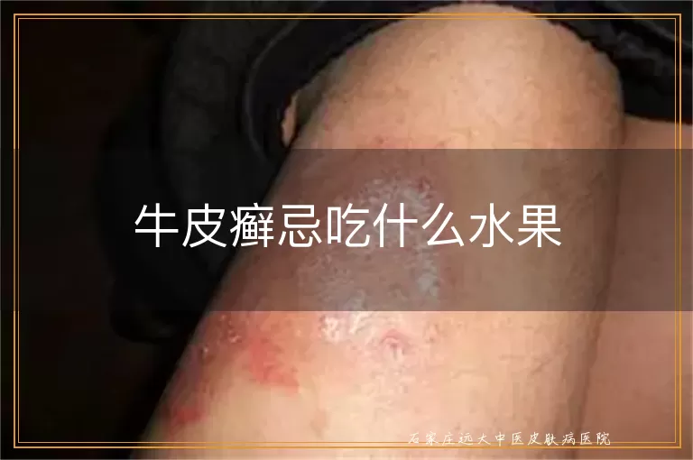 牛皮癣忌吃什么水果
