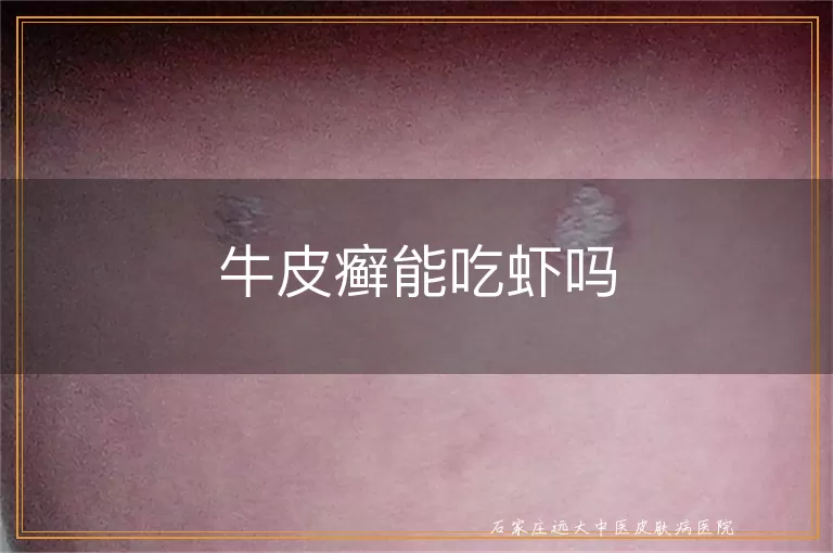 牛皮癣能吃虾吗