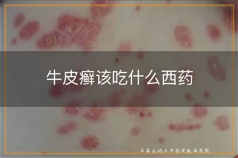 牛皮癣该吃什么西药