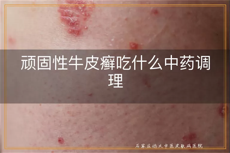 顽固性牛皮癣吃什么中药调理
