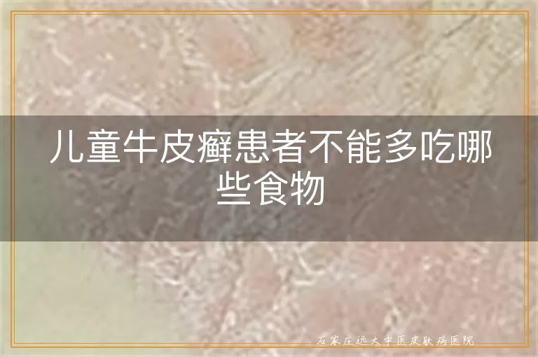 儿童牛皮癣患者不能多吃哪些食物