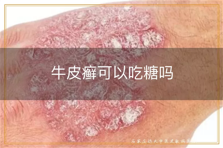 牛皮癣可以吃糖吗