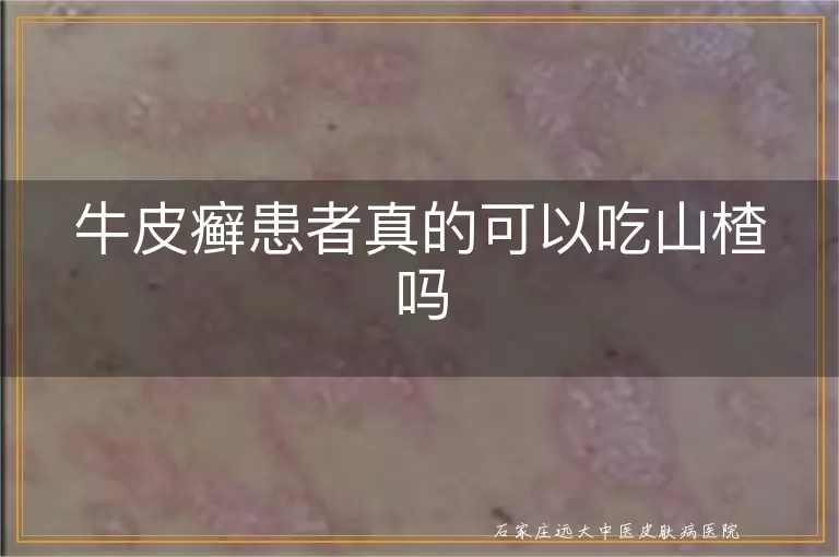 牛皮癣患者真的可以吃山楂吗