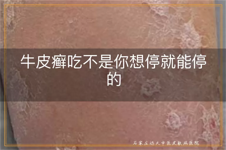 牛皮癣吃不是你想停就能停的