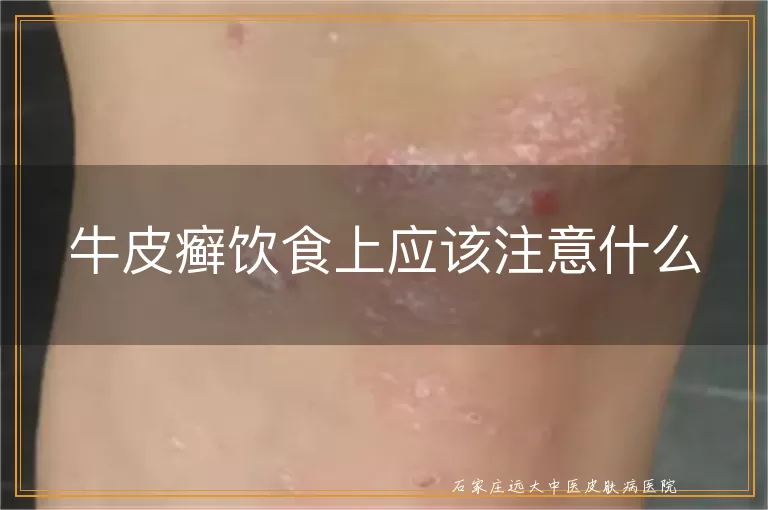 牛皮癣饮食上应该注意什么