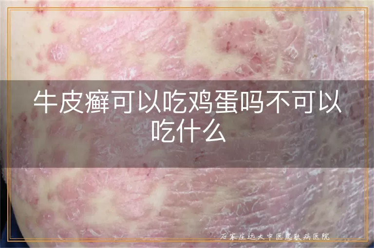 牛皮癣可以吃鸡蛋吗不可以吃什么