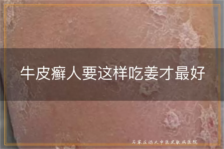 牛皮癣人要这样吃姜才最好