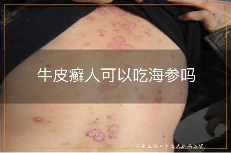 牛皮癣人可以吃海参吗