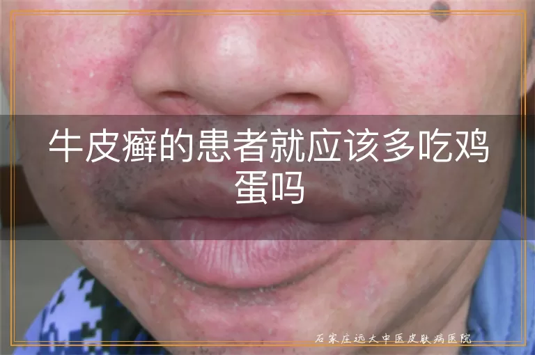 牛皮癣的患者就应该多吃鸡蛋吗