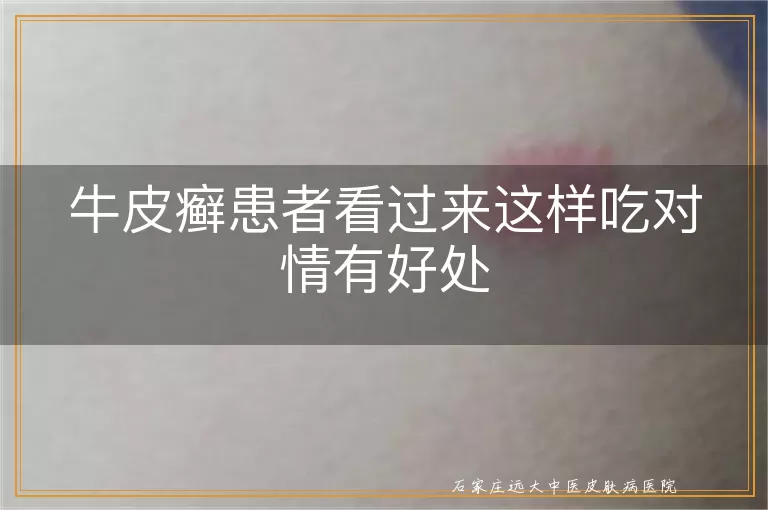 牛皮癣患者看过来这样吃对情有好处