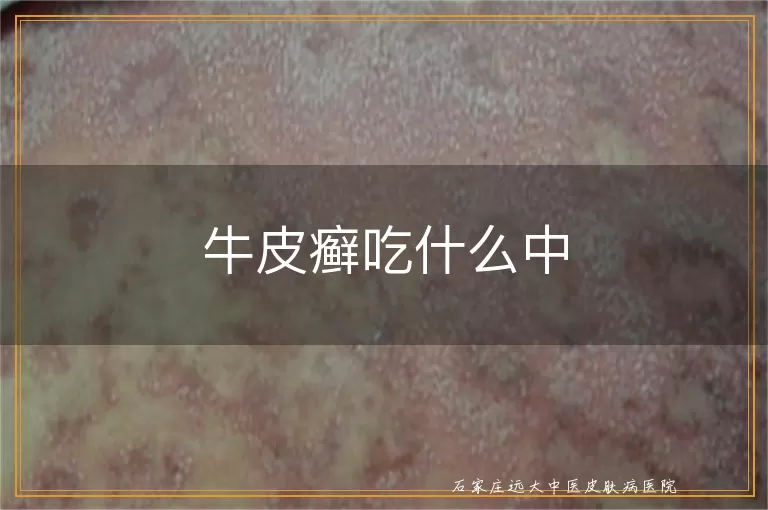牛皮癣吃什么中
