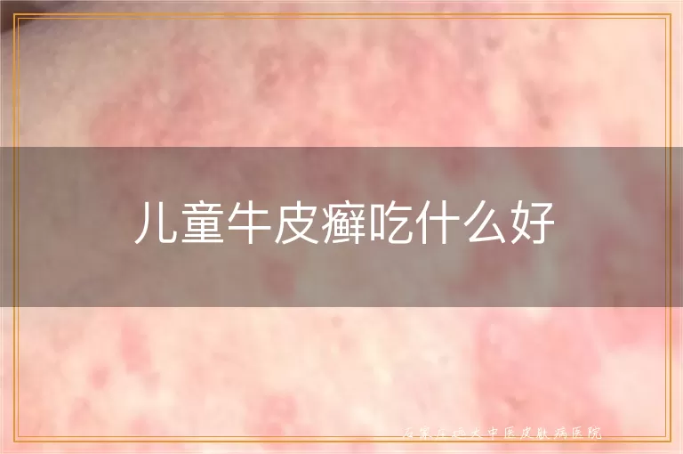 儿童牛皮癣吃什么好