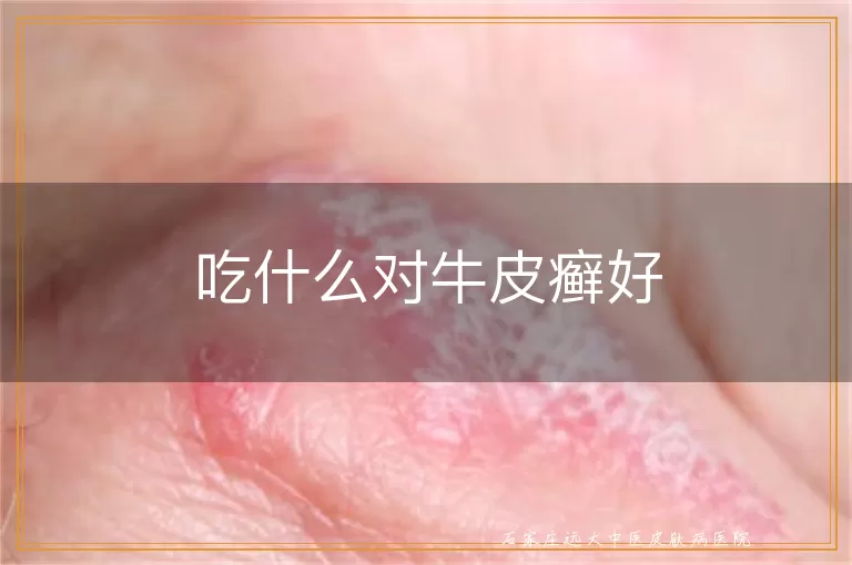 吃什么对牛皮癣好