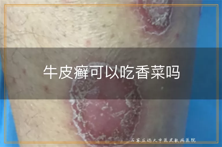 牛皮癣可以吃香菜吗