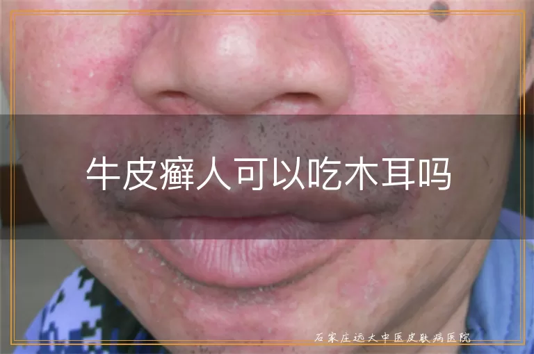 牛皮癣人可以吃木耳吗