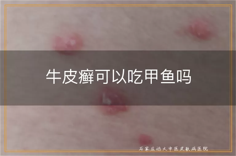 牛皮癣可以吃甲鱼吗