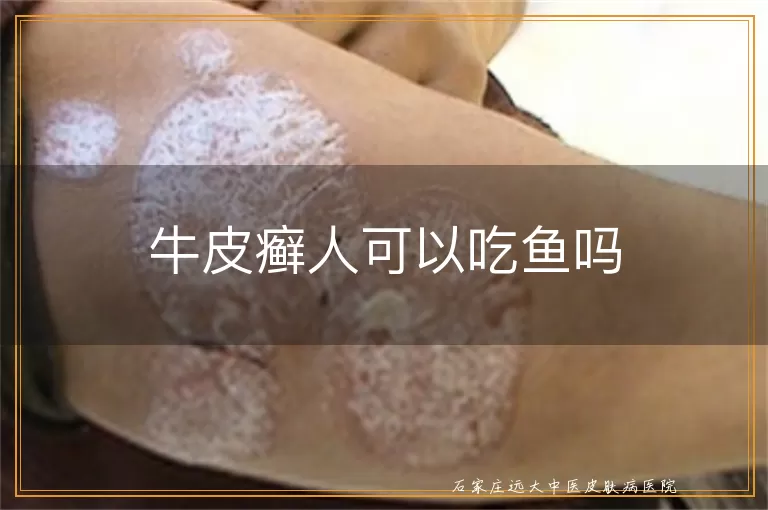 牛皮癣人可以吃鱼吗