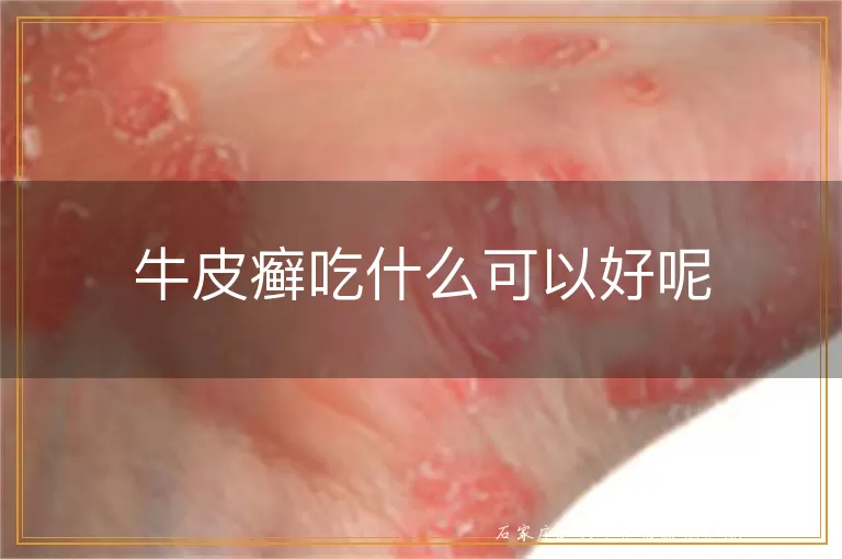 牛皮癣吃什么可以好呢