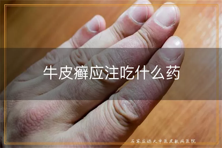 牛皮癣应注吃什么药