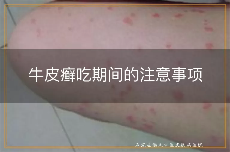 牛皮癣吃期间的注意事项