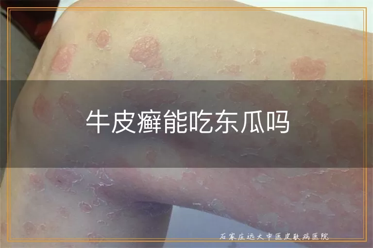 牛皮癣能吃东瓜吗