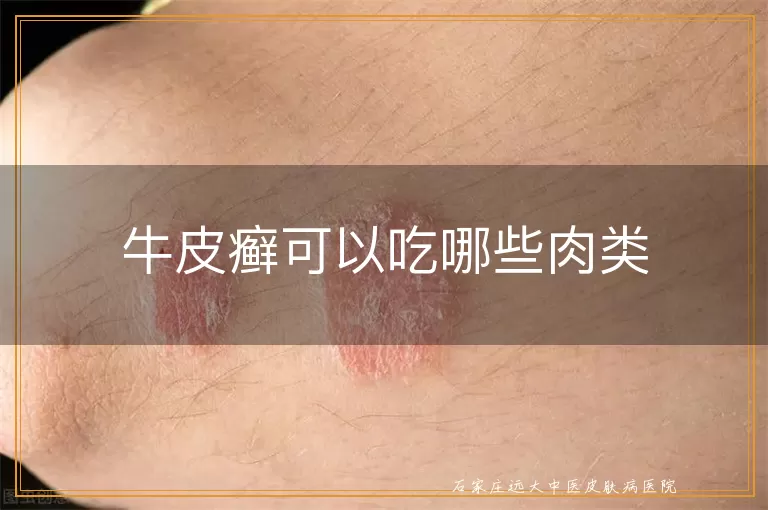 牛皮癣可以吃哪些肉类