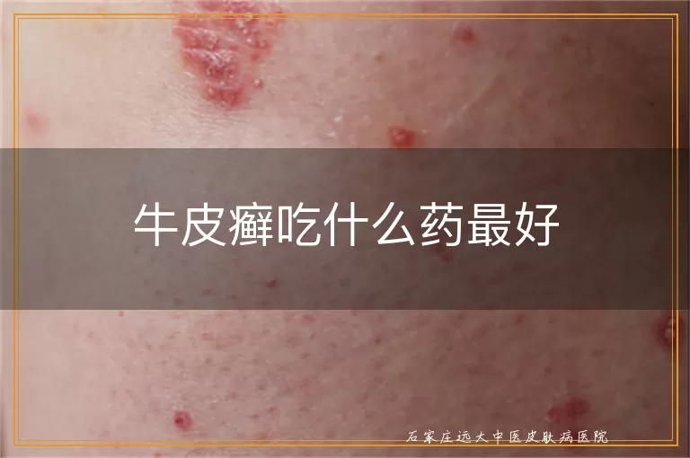 牛皮癣吃什么药最好