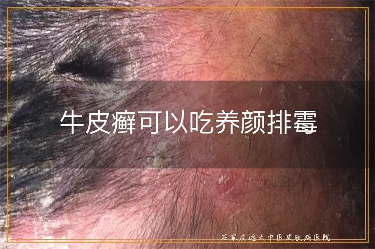 牛皮癣可以吃养颜排霉