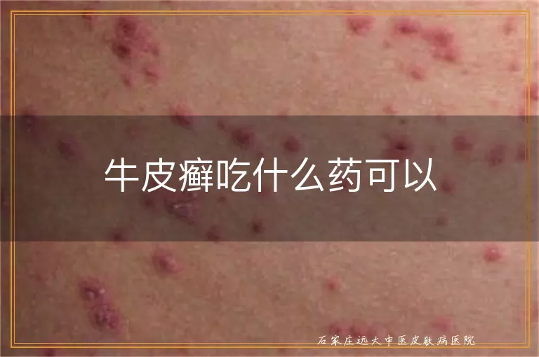 牛皮癣吃什么药可以