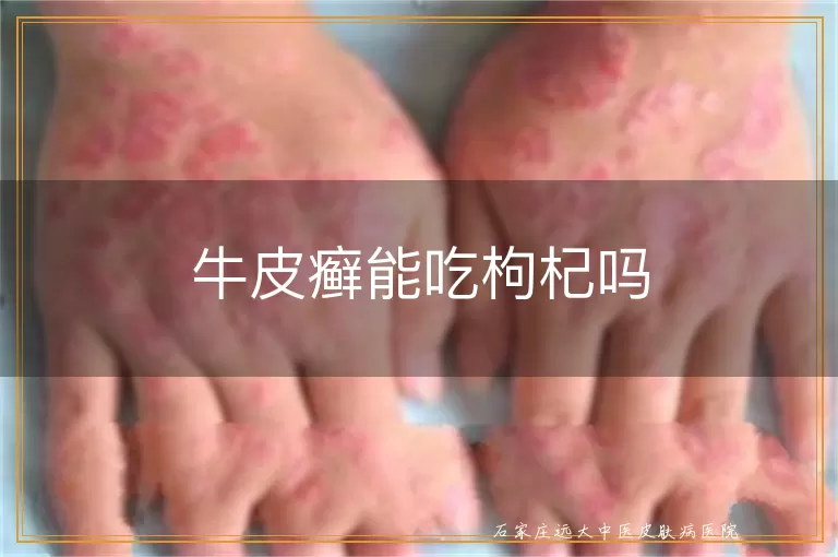 牛皮癣能吃枸杞吗