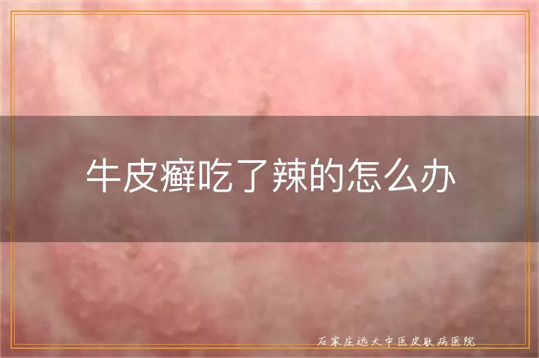 牛皮癣吃了辣的怎么办
