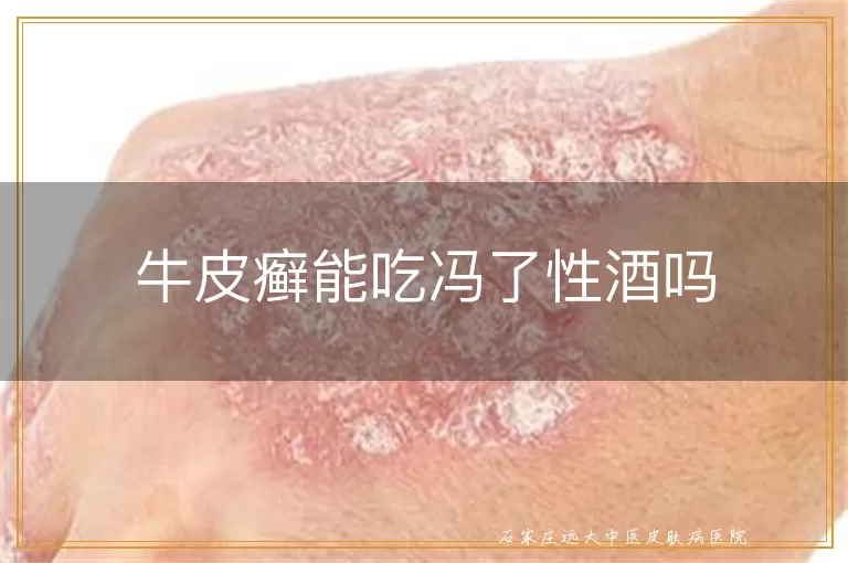 牛皮癣能吃冯了性酒吗