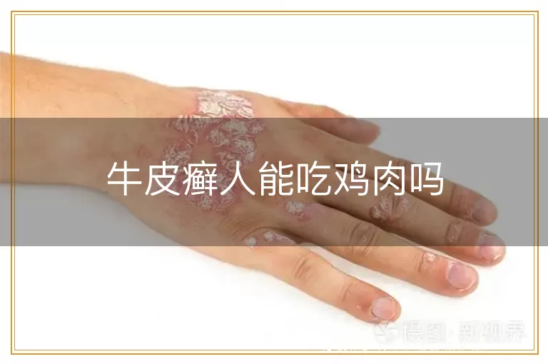 牛皮癣人能吃鸡肉吗