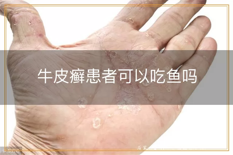 牛皮癣患者可以吃鱼吗